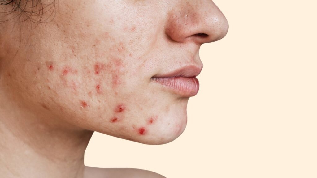 4 Lifestyle Changes to Reduce Acne-Prone Skin Breakouts